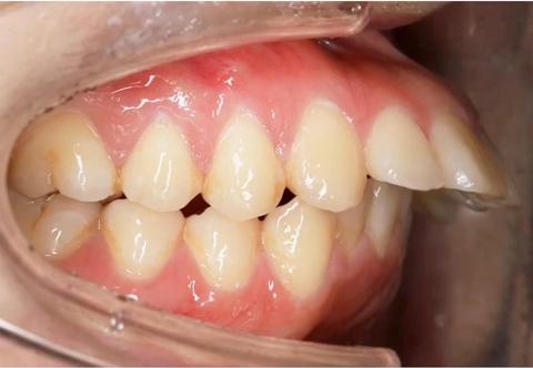 5 Điều Cần Biết Khi Niềng Răng Hô 